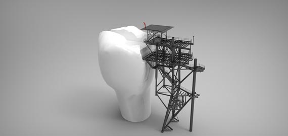 Karies-Füllungstherapie